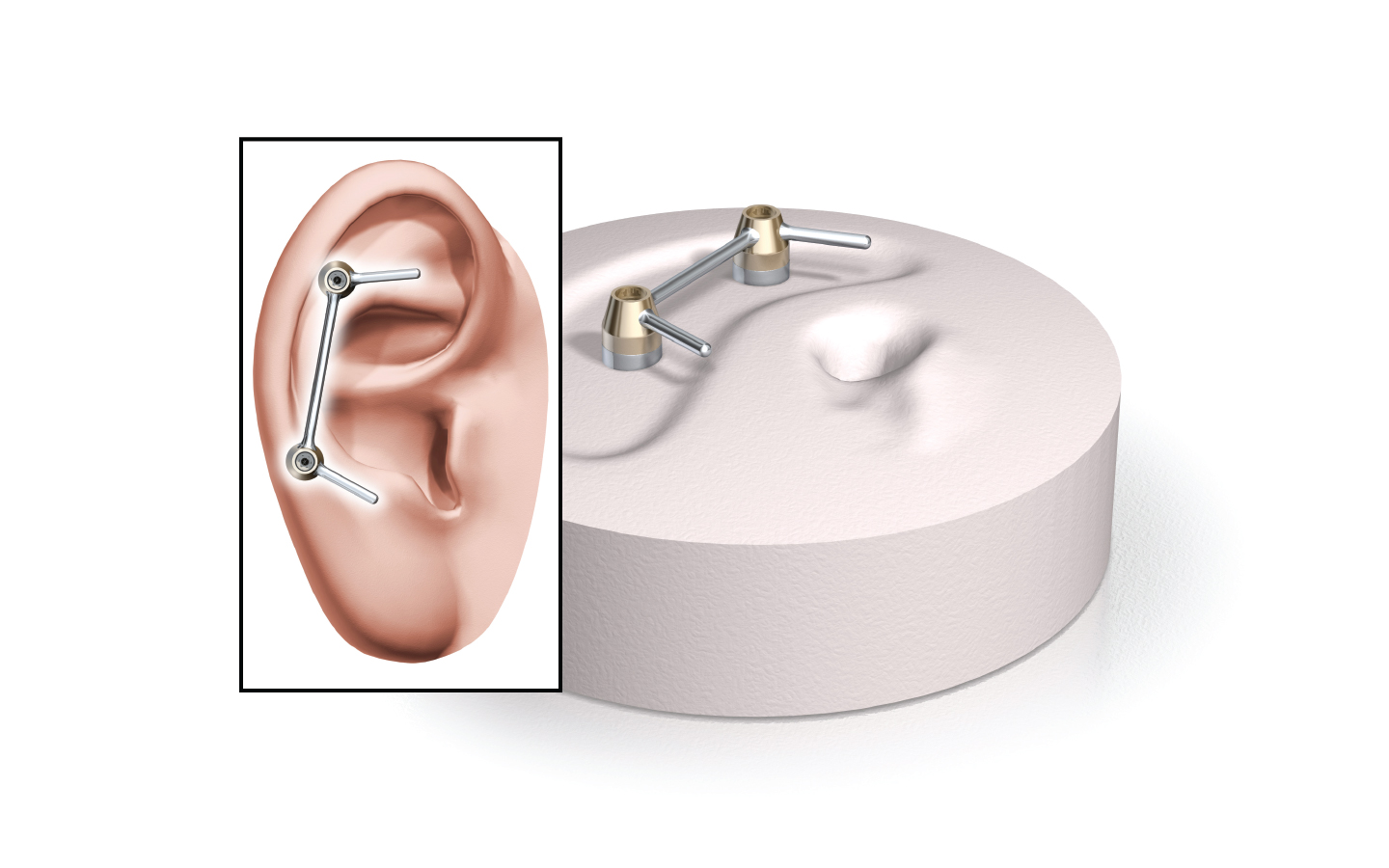 Illustration des implants du système Vistafix et de l’oreille prothétique